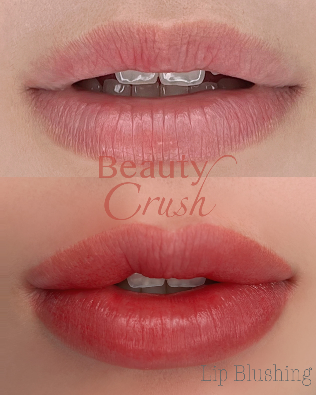 입술 시술 전후